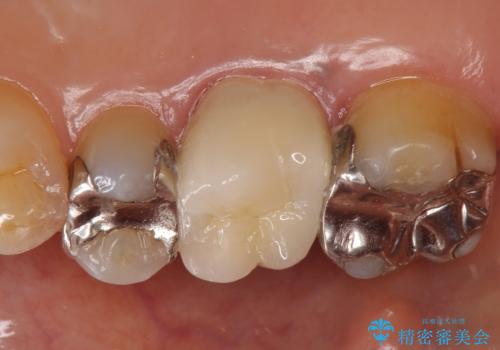 オールセラミッククラウン　銀歯と歯茎の隙間が気になるの治療後