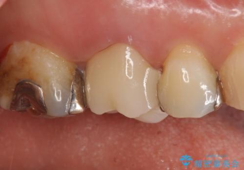 オールセラミッククラウン　銀歯と歯茎の隙間が気になるの治療後
