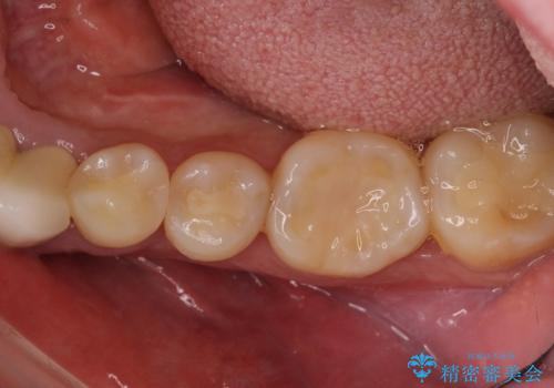 舌側の骨隆起切除とセラミックインレーによるむし歯治療の症例 治療後