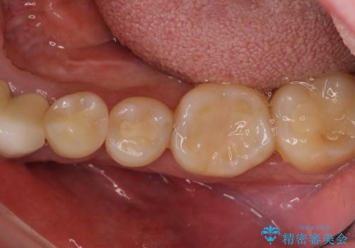 舌側の骨隆起切除とセラミックインレーによるむし歯治療