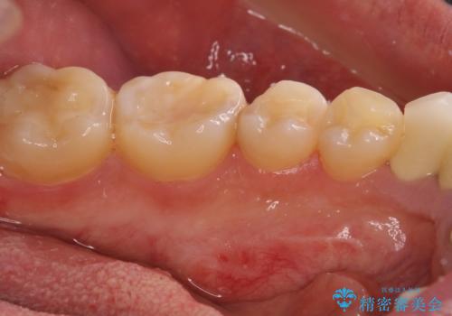 舌側の骨隆起切除とセラミックインレーによるむし歯治療の治療後