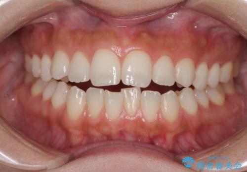 前歯のオープンバイトを治したい インビザラインでの矯正治療