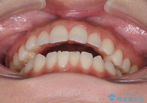 前歯のオープンバイトを治したい インビザラインでの矯正治療の治療前