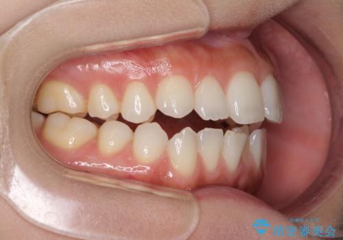 前歯のオープンバイトを治したい インビザラインでの矯正治療の治療前