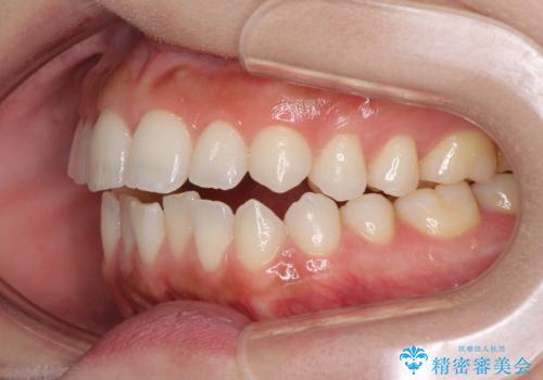前歯のオープンバイトを治したい インビザラインでの矯正治療の治療前