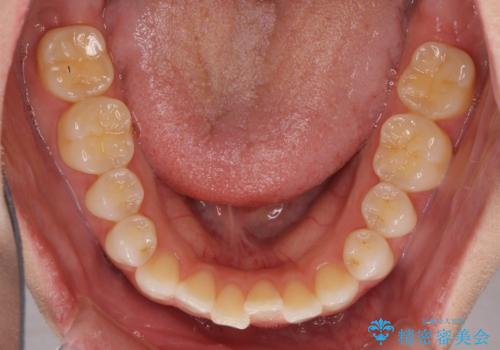 前歯のオープンバイトを治したい インビザラインでの矯正治療の治療前