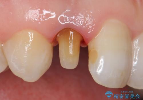 オールセラミッククラウン 変色が気になる前歯の治療の治療中