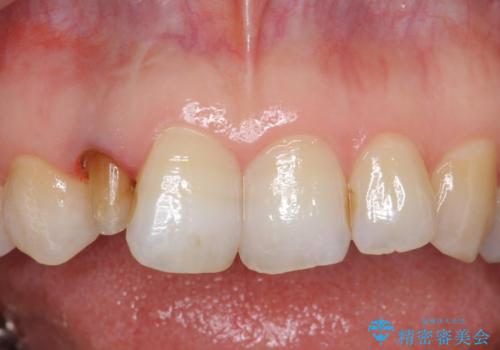 オールセラミッククラウン　変色が気になる前歯の治療の治療中