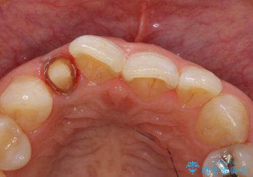 オールセラミッククラウン 変色が気になる前歯の治療の治療中