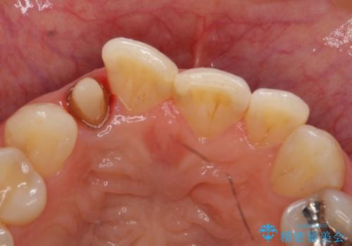 オールセラミッククラウン 変色が気になる前歯の治療の治療中