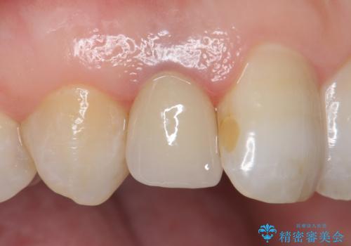 オールセラミッククラウン　変色が気になる前歯の治療の治療後