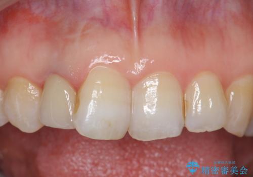 オールセラミッククラウン　変色が気になる前歯の治療の治療後