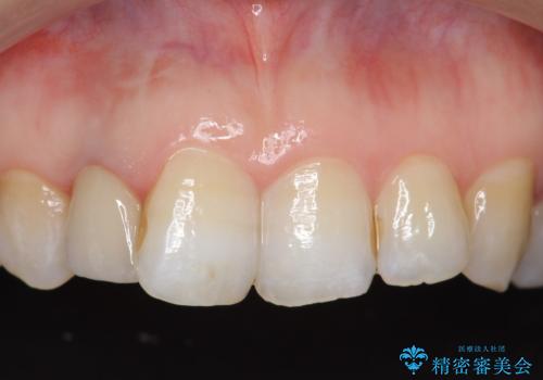 オールセラミッククラウン 変色が気になる前歯の治療の治療後