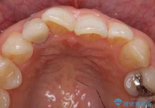 オールセラミッククラウン 変色が気になる前歯の治療の治療後