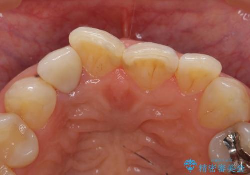 オールセラミッククラウン 変色が気になる前歯の治療の治療後