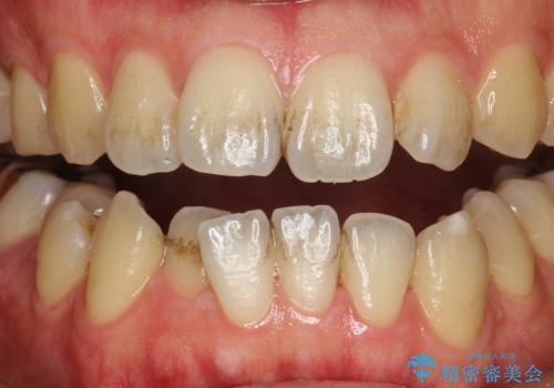 お茶により濃くついた着色落としの治療前