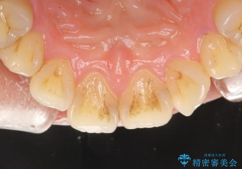 お茶により濃くついた着色落としの治療前