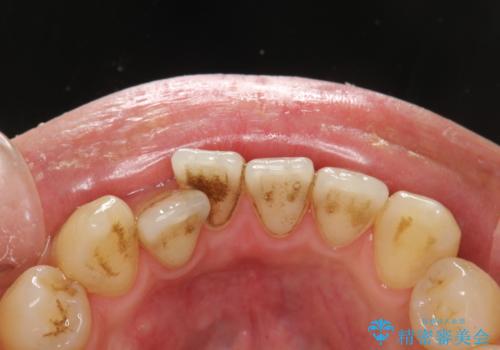 お茶により濃くついた着色落としの治療前