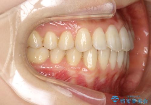 前歯のガタガタをインビザラインで目立たず矯正の症例 治療後