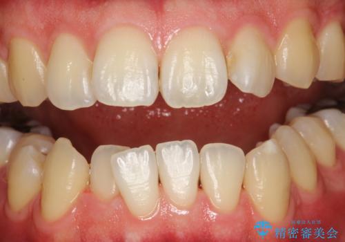 お茶により濃くついた着色落としの治療後