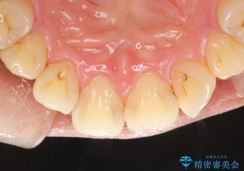 お茶により濃くついた着色落としの治療後