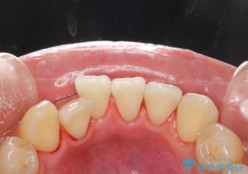 お茶により濃くついた着色落としの治療後