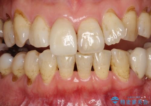 つきやすいステインを定期的にpmtcできれいにクリーニングの治療前