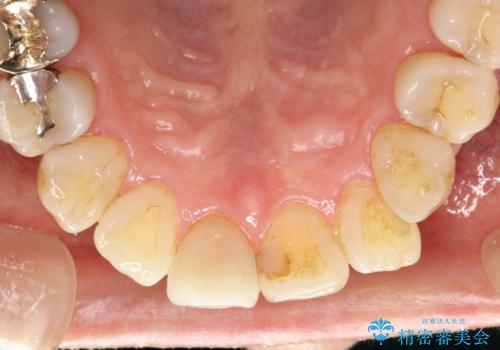 つきやすいステインを定期的にpmtcできれいにクリーニングの治療前