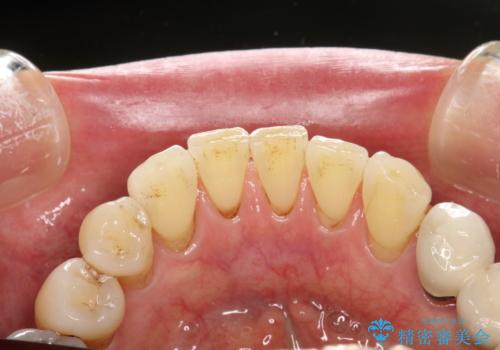 つきやすいステインを定期的にpmtcできれいにクリーニングの治療前