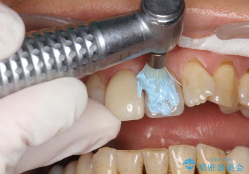 つきやすいステインを定期的にpmtcできれいにクリーニングの治療中