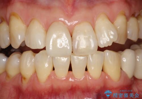 つきやすいステインを定期的にpmtcできれいにクリーニングの治療後