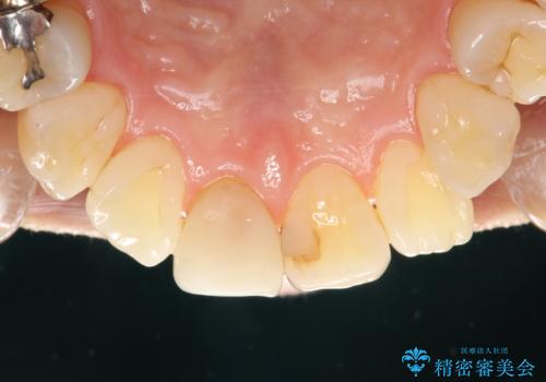 つきやすいステインを定期的にpmtcできれいにクリーニングの治療後