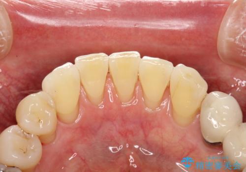 つきやすいステインを定期的にpmtcできれいにクリーニングの治療後