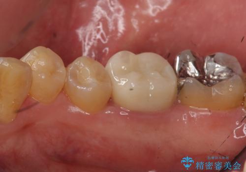 つめものが取れたのを放置 神経の治療からやりかえの症例 治療後