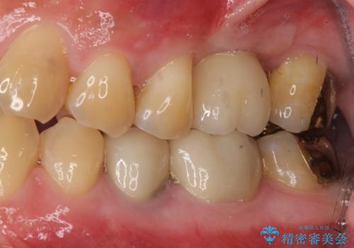 上の奥歯のインプラント、全体的な虫歯治療の症例 治療後