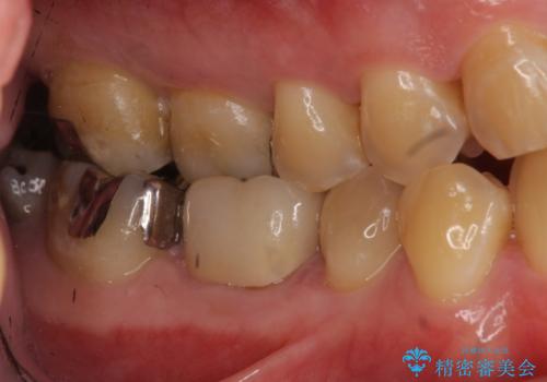 つめものが取れたのを放置 神経の治療からやりかえの治療後