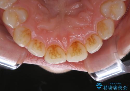 ワインによる着色・黄ばみをPMTCできれいにの治療前