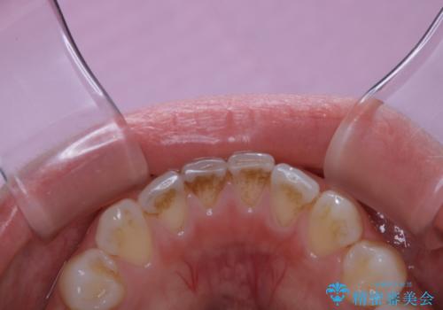 ワインによる着色・黄ばみをPMTCできれいにの治療前