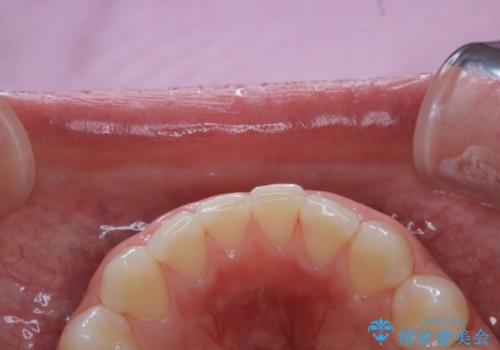 ワインによる着色・黄ばみをPMTCできれいにの治療後