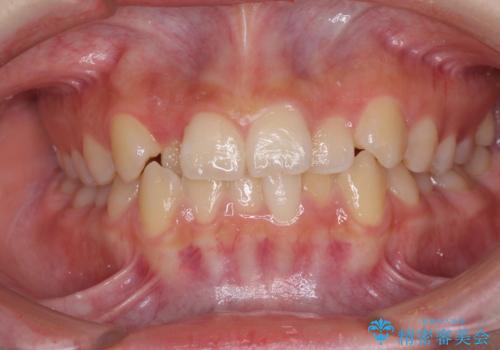 前歯のクロスバイト　メタル装置での矯正治療の症例 治療前