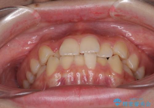 前歯のクロスバイト　メタル装置での矯正治療の治療前