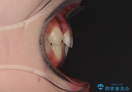 前歯のクロスバイト メタル装置での矯正治療の治療前