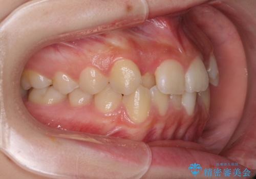 前歯のクロスバイト メタル装置での矯正治療の治療前