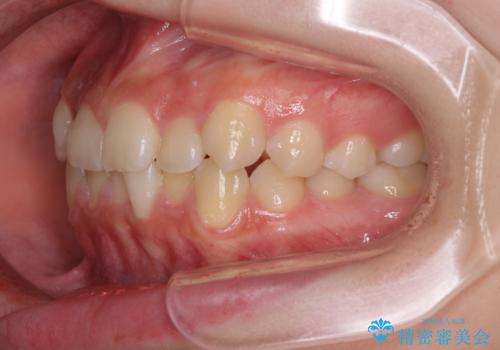 前歯のクロスバイト メタル装置での矯正治療の治療前