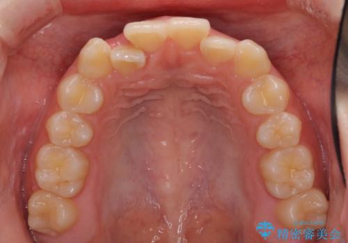 前歯のクロスバイト メタル装置での矯正治療の治療前