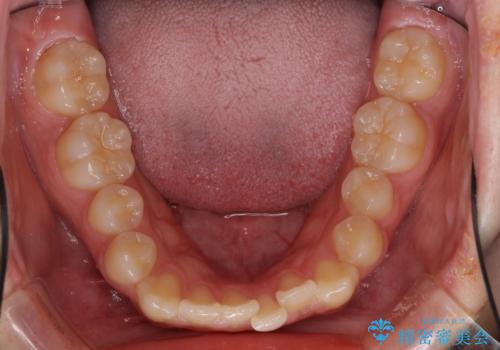 前歯のクロスバイト メタル装置での矯正治療の治療前