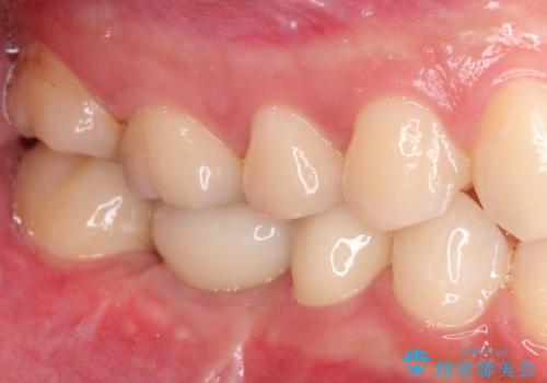 保存不可能な歯を抜歯してインプラント治療の症例 治療後