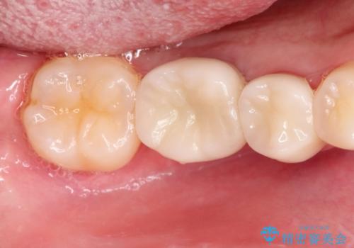 保存不可能な歯を抜歯してインプラント治療の治療後