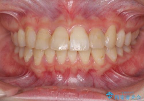 継ぎ接ぎだらけの前歯を綺麗にしたい 前歯のオールセラミックの治療前