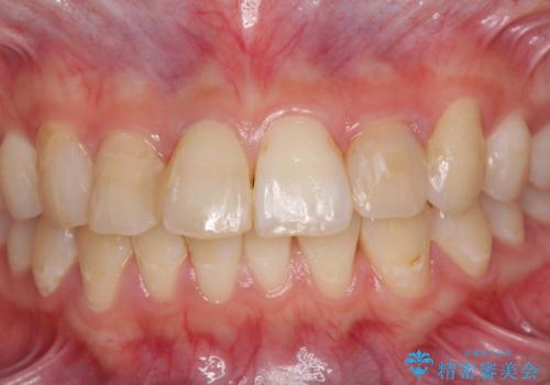 継ぎ接ぎだらけの前歯を綺麗にしたい 前歯のオールセラミックの治療前